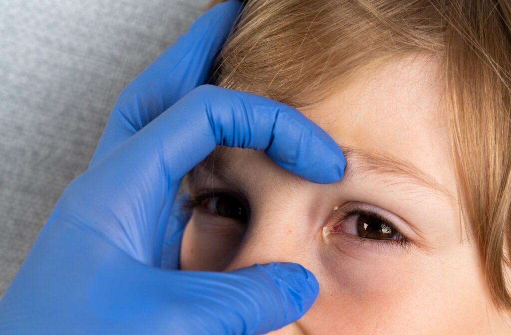 An optometrist examines a child's eye, which is obviously infected from conjunctivitis.